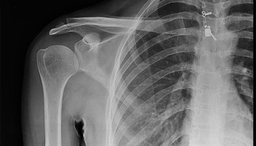 X-ray technique of straight shoulder joint