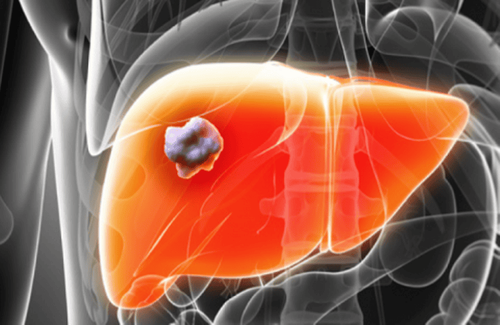 Advantages of treating liver tumors with radiofrequency waves