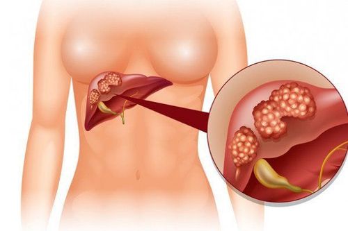 Làm thế nào để nhận diện u gan lành tính?