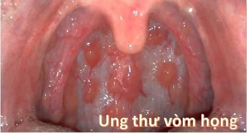 Classification and progression of nasopharyngeal cancer