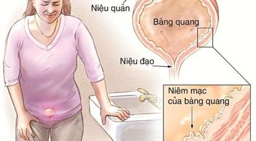 
Có rất nhiều nguyên nhân gây bàng quang thần kinh
