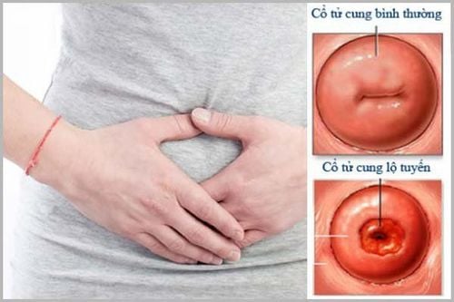 Effects of cervical ectropion during pregnancy