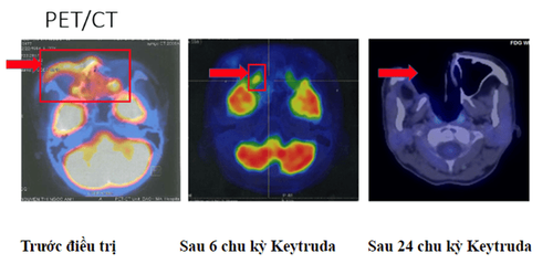 
Sau 2 năm với 35 chu kỳ điều trị của Keytruda và theo dõi sát sao, người bệnh không có dấu hiệu tái phát - di căn
