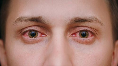 Nhận diện các loại viêm kết mạc mắt