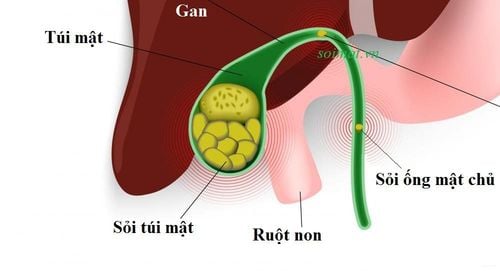 Advantages of laparoscopic gallbladder stone surgery