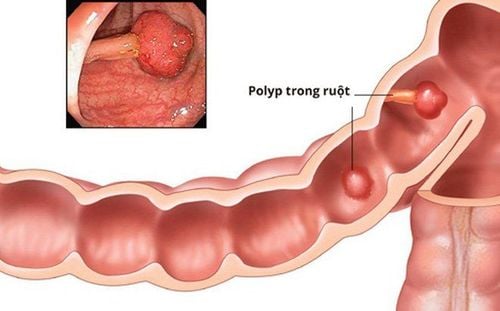 Common types of colorectal polyps