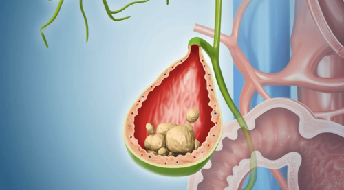 Gallbladder sludge has few warning symptoms