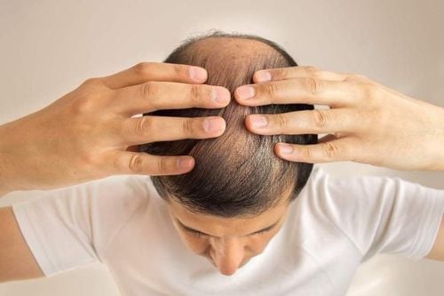 Bị rụng tóc và hói đầu có cách nào khắc phục không? Có thể sử dụng tế bào gốc không?