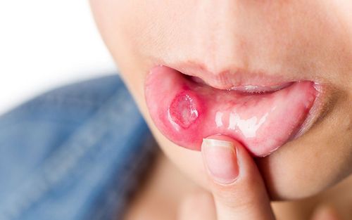 Bệnh lậu ở họng, miệng: Những điều cần biết