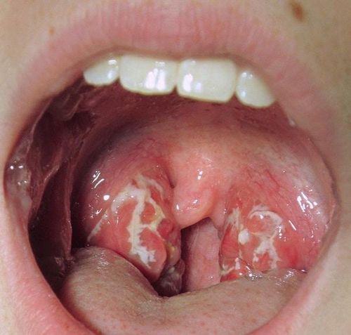 The reason why a sore throat lasts forever can't be cured completely