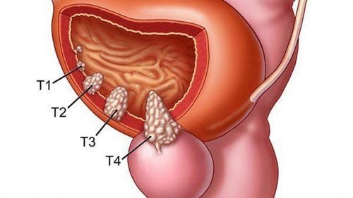 Developmental stages of bladder cancer