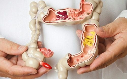 Treatment options for colorectal polyps