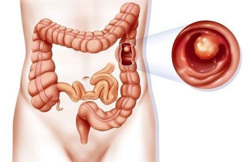 
Bệnh lý Polyp đại tràng
