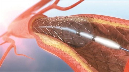 How long does a coronary stent stay in your body?