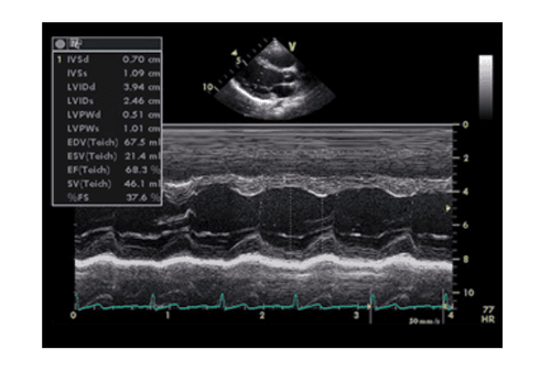 TM echocardiography and what you need to know