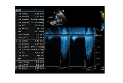 
Phổ Doppler liên tục của hẹp nặng van động mạch chủ
