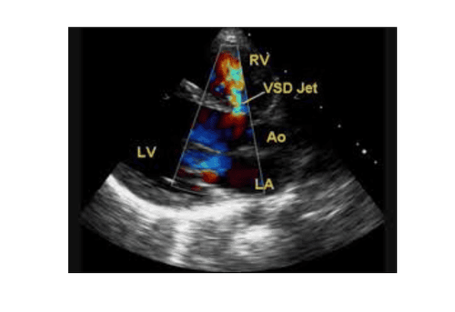 
Thông liên thất được phát hiện bằng Doppler mầu (VSD jet): dòng chảy từ thất trái (LV) qua vách liên thất sang thất phải (RV), đi về phía đầu dò được để ở phía thất phải nên có mầu khảm đỏ
