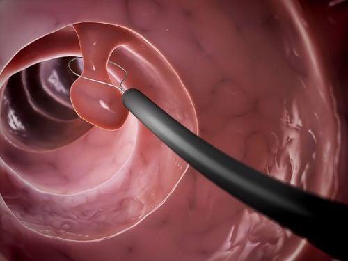 Endoscopic resection of gastrointestinal polyps > 1 cm or multiple polyps