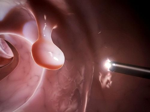 Polyp đại tràng mọc lại sau 6 tháng phẫu thuật cắt bỏ phải làm sao?