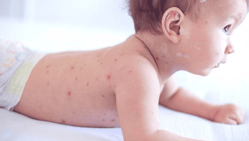 Measles is likely to cause complications in which subjects?