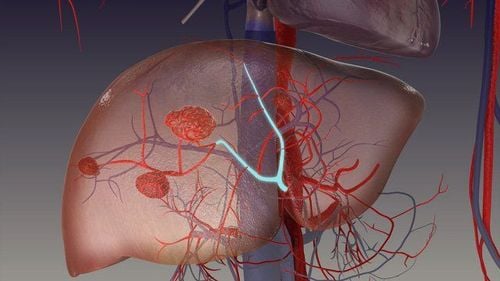 Complications of hemangiomas in the liver