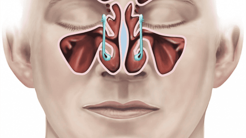 Advantages of endoscopic sinus surgery