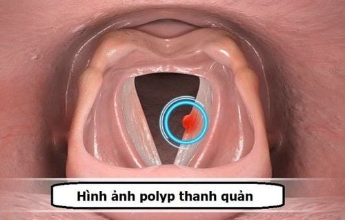 
Hình ảnh polyp thanh quản
