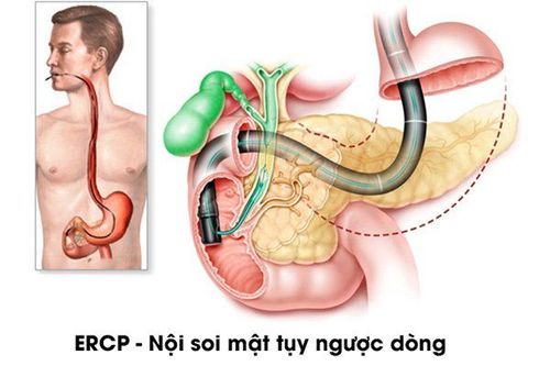 
Kỹ thuật nội soi mật tuy ngược dòng được sử dụng trong chẩn đoán viêm tụy mạn/sỏi tụy
