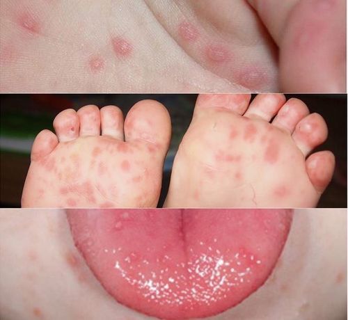 Subjects prone to hand, foot and mouth disease