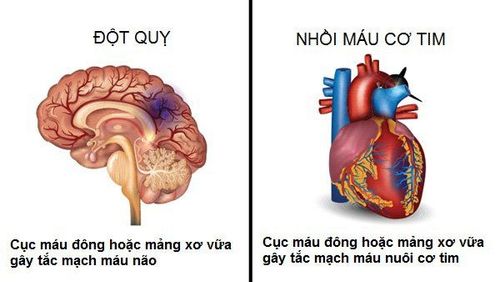 
Nhồi máu cơ tim có thể gây ra bệnh cuồng nhĩ
