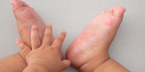 Signs of worsening hand, foot and mouth disease