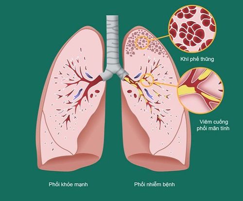 
Bệnh nhân mắc bệnh phổi tắc nghẽn mạn tính (COPD) nặng
