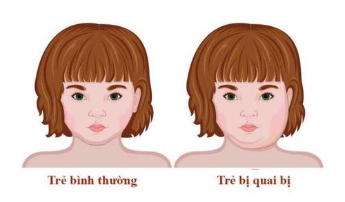 
Quai bị là một bệnh truyền nhiễm
