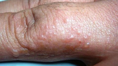 Typical signs of scabies