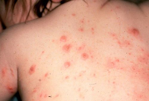 How to treat scabies in children?