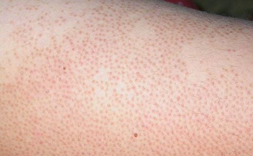 Factors that easily cause folliculitis