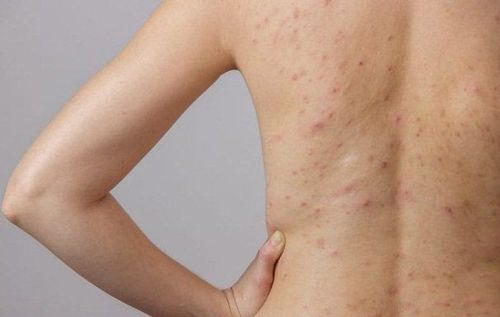 How to treat folliculitis?