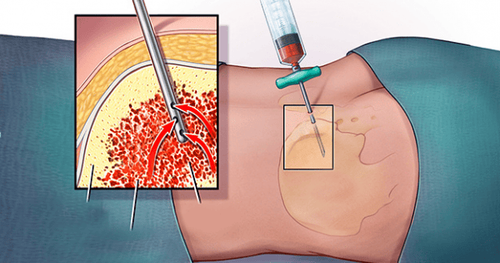 Bone marrow aspiration in what cases?