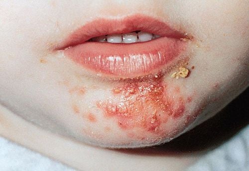 Prevent the spread of impetigo