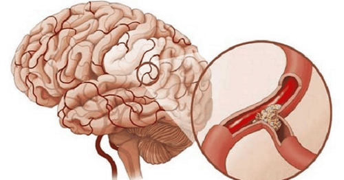 Tai biến mạch máu não nhẹ: Đừng chủ quan