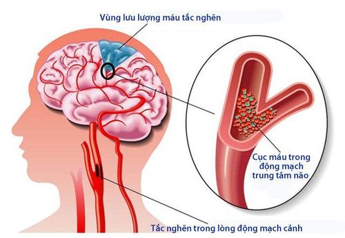 
Tai biến mạch máu não nhẹ có biến chứng nguy hiểm không nên chủ quan
