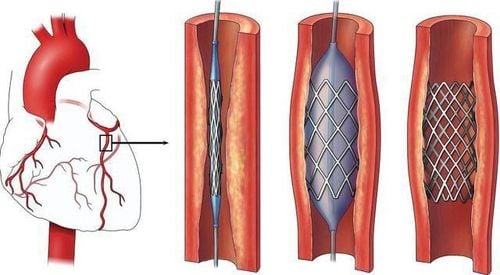 
Hình ảnh đặt Stent mạch vành
