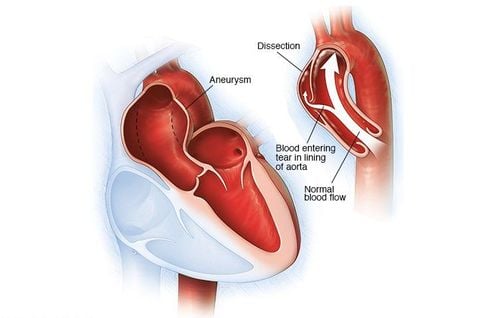 Aortic aneurysm: In which case is a stent graft placed?