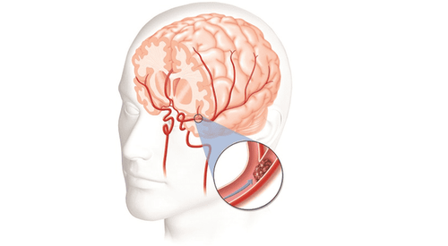 Atherosclerosis of the brain can cause stroke