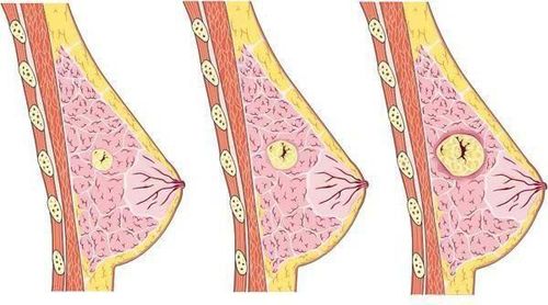 Is fibroadenoma related to cancer?