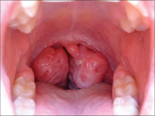 Enlarged tonsils cause snoring?