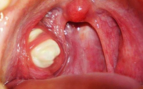 Is tonsillitis pus-filled with pox dangerous?