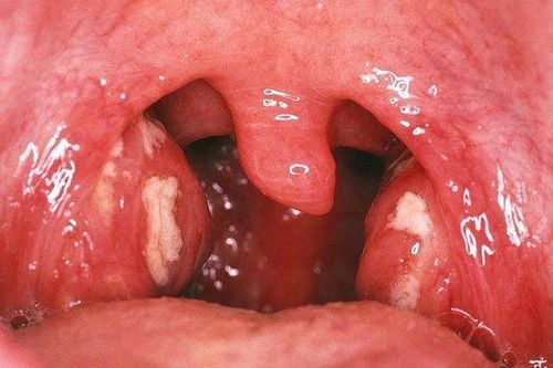 What is the white spot on the tonsils?