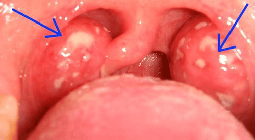 What is aggravating tonsillitis?