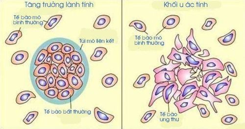 
Sự khác nhau giữa bướu lành tính và bướu ác tính
